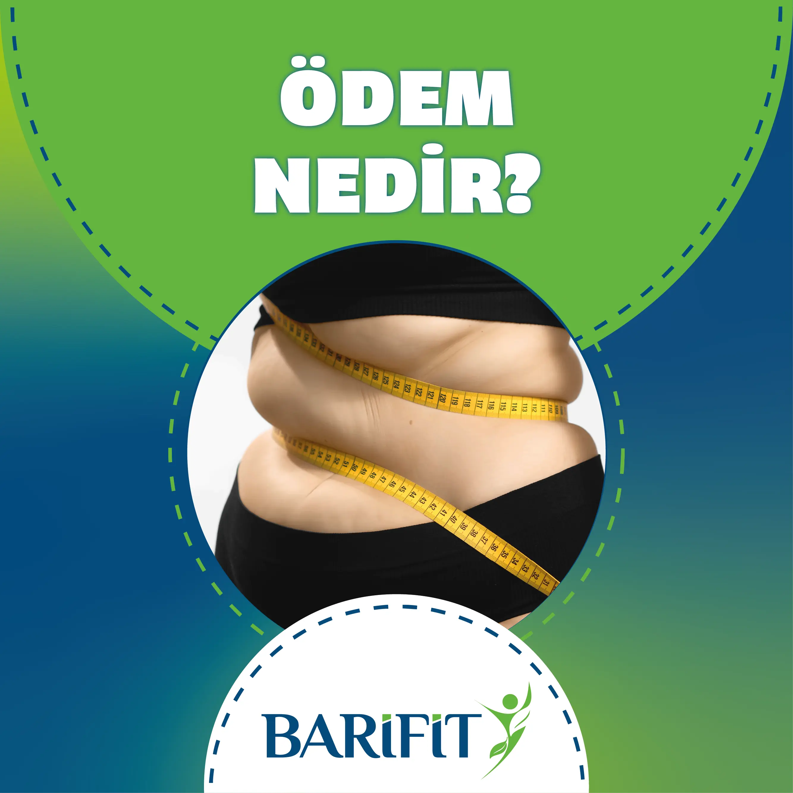 Ödem Nedir?